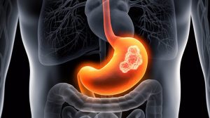 cáncer estomago