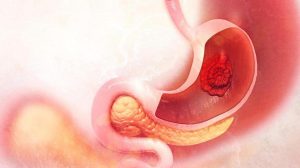 Cáncer de estomago