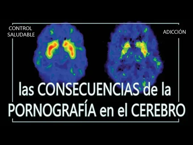 Consecuencias de la pornografía en el cerebro Consecuencias de la pornografía en el cerebro
