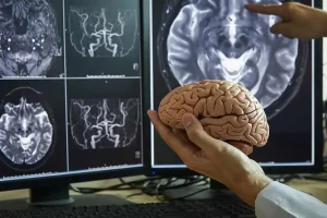 Medico estudio cerebro Alzhéimer