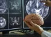 Medico estudio cerebro Alzhéimer