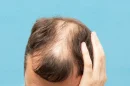 Alopecia