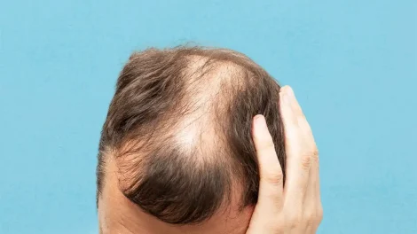 Alopecia