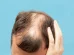 Alopecia