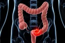 Cáncer de colon