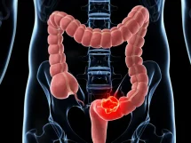 Cáncer de colon
