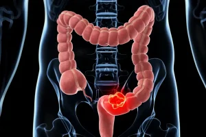 Cáncer de colon