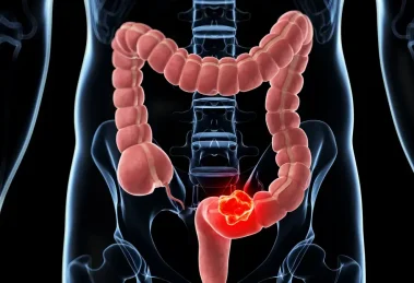 Cáncer de colon