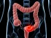 Cáncer de colon