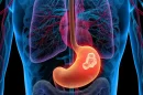 Cáncer de estomago