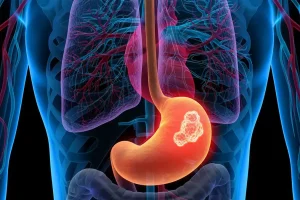 Cáncer de estomago