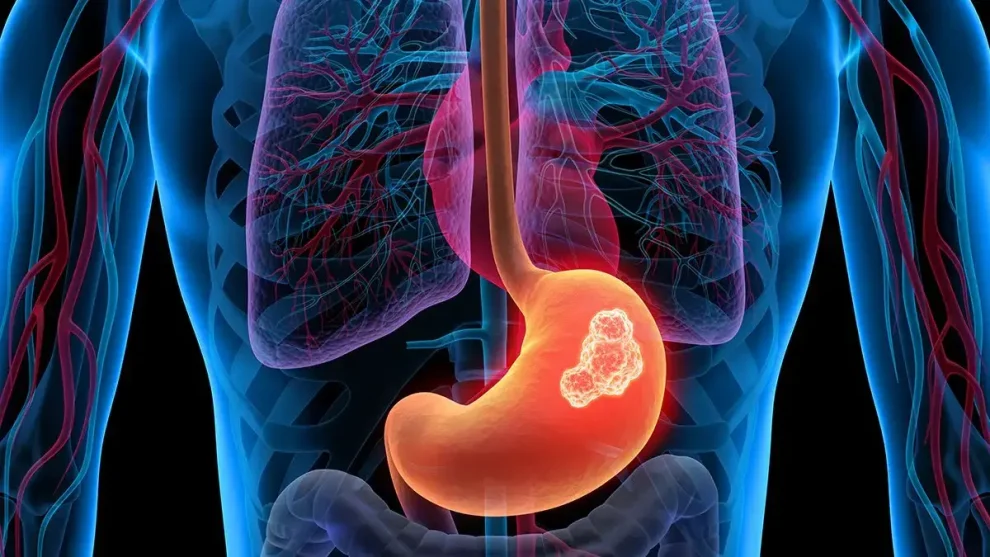 Cáncer de estomago