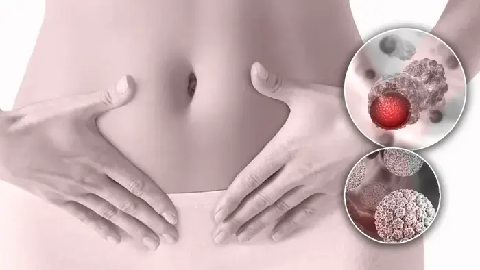 Tipos de cáncer que podrían padecer las personas con VPH Tipos de cáncer que podrían padecer las personas con VPH