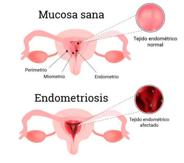 Endometriosis