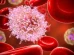 Leucemia linfocítica crónica