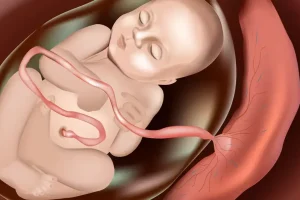 El ring de la placenta