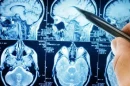 cerebro electroencefalograma