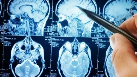 cerebro electroencefalograma