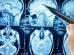 cerebro electroencefalograma