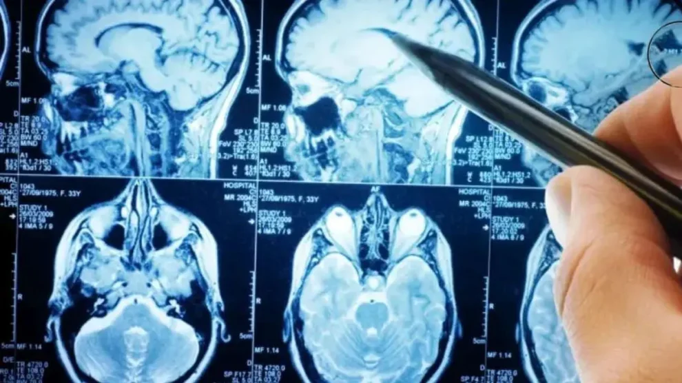 cerebro electroencefalograma