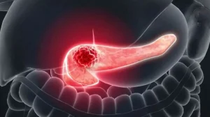 Cáncer de páncreas