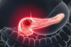 Cáncer de páncreas