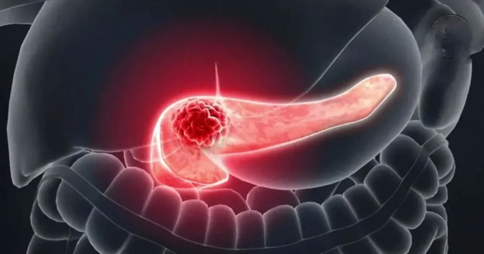 Cáncer de páncreas