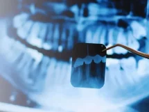 Células madre para regenerar dientes