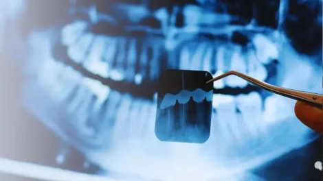 Células madre para regenerar dientes