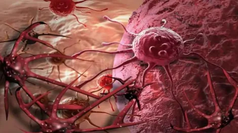 Identifican proteína causante de metástasis