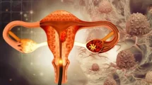Prueba que permitirá detectar la endometriosis en tan solo unas horas