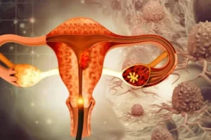 Prueba que permitirá detectar la endometriosis en tan solo unas horas