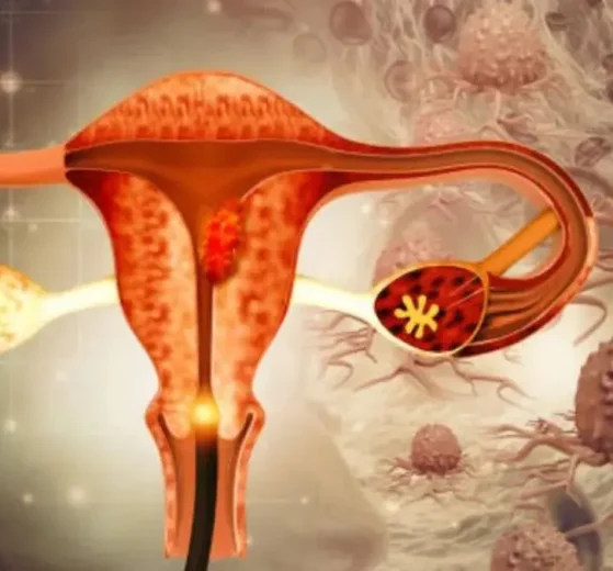 Prueba que permitirá detectar la endometriosis en tan solo unas horas