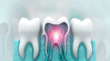 Nanorobots dentales