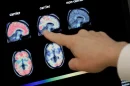 Cada vez mas cerca hacer el Alzheimer reversible