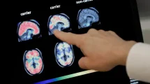 Cada vez mas cerca hacer el Alzheimer reversible
