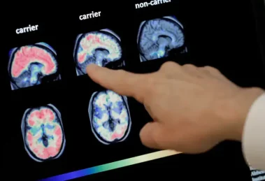 Cada vez mas cerca hacer el Alzheimer reversible