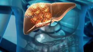Refresco Cáncer de Hígado