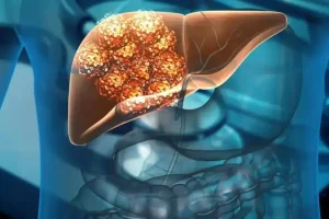 Refresco Cáncer de Hígado