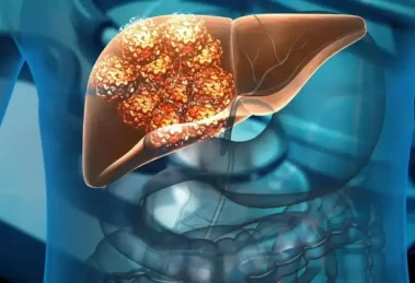 Refresco Cáncer de Hígado