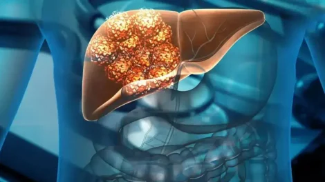 Refresco Cáncer de Hígado