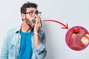 tonsilolitos mal aliento