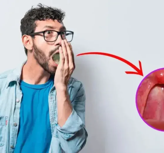 tonsilolitos mal aliento