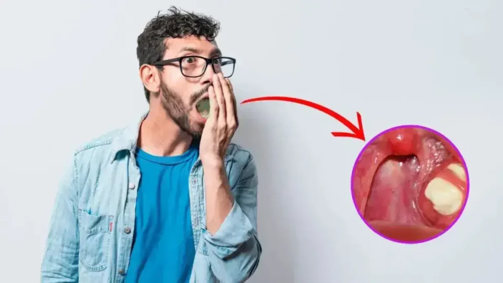 tonsilolitos mal aliento