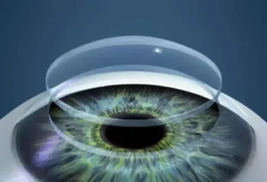 Córnea a partir de escamas de pescado