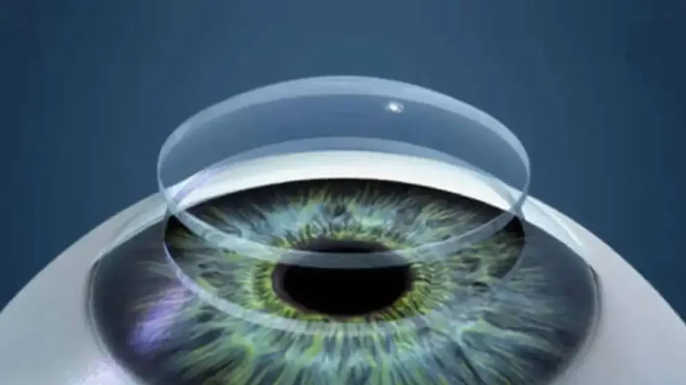 Córnea a partir de escamas de pescado