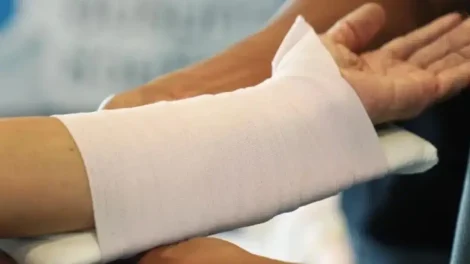 Fractura implante biodegradable
