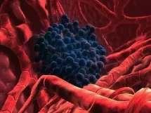 Cáncer de hígado