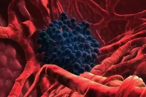 Cáncer de hígado