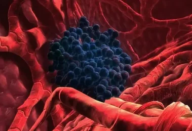 Cáncer de hígado